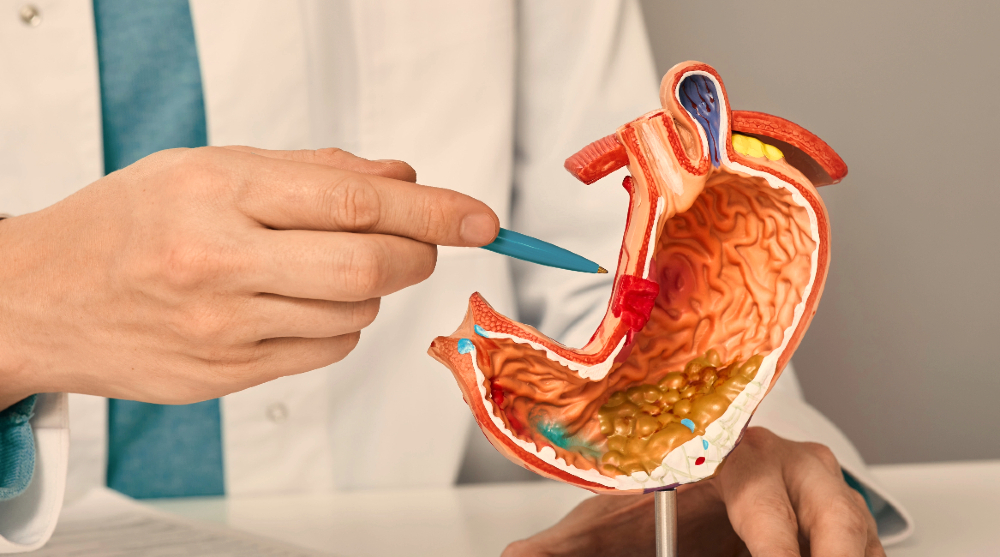 gastric ulcer.jpg
